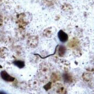 Cork-screw morphology of a spirochete (Warthin-Starry, oil immersion ...