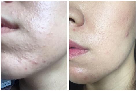 Ghim của X D trên Gua sha | Mụn, Phun xăm, Điều trị da