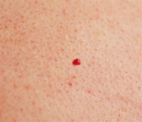 Cherry Angiomas - Pictures, Symptoms, Causes, Treatment, Removal | HealDove