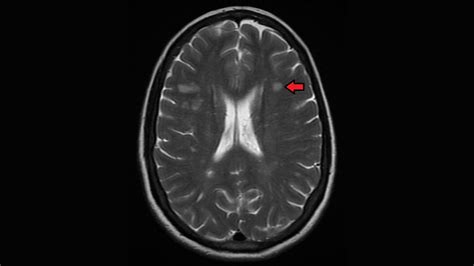 Ms Brain Mri With Contrast