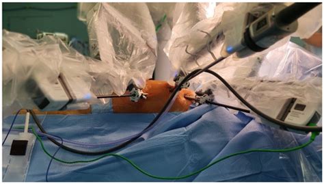 JPM | Free Full-Text | A Single Center Initial Experience with Robotic-Assisted Minimally ...