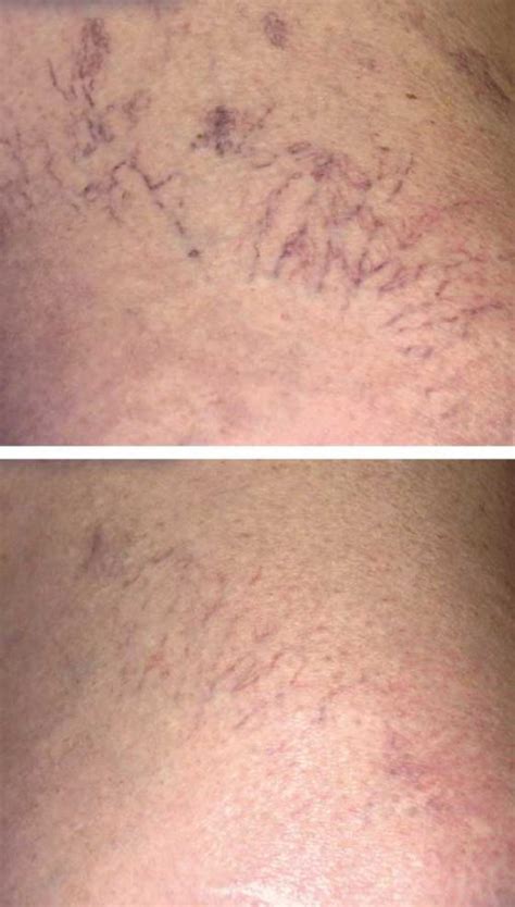 Thread Vein Removal (Carlisle) - Fast, Permanent Results | VL Aesthetics