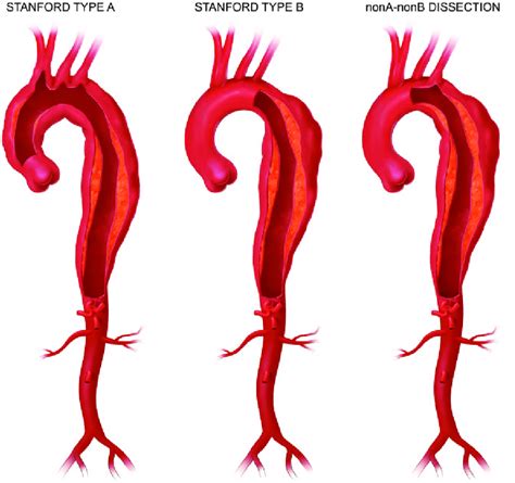 Aortic Dissection