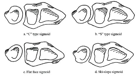 Sigmoid notch shapes. (a) "C" type sigmoid. (b) "S" type sigmoid. (c)... | Download Scientific ...