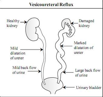 Vesicoureteral Reflux (VUR) Causes, Symptoms | Health, Entertainment ...