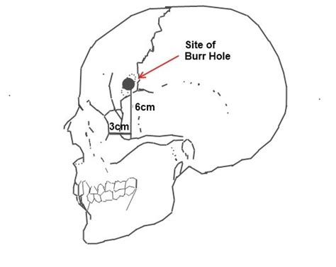 Lobotomy (prefrontal leukotomy) – what it was about, side effects ...