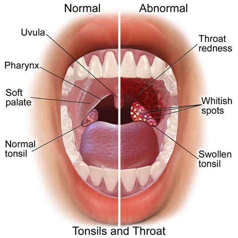 Strep Throat VS Sore Throat - Causes, Treatments, Preventions