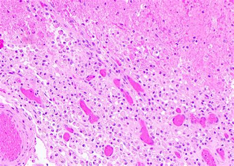 Diffuse Axonal Injury Histology