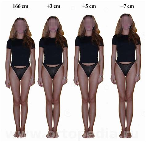 Cosmetic height increase (limb lengthening) | Weight bearing exercises ...