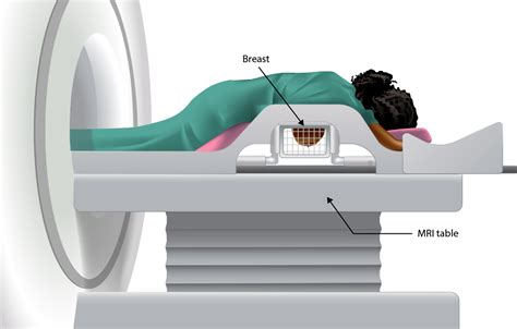 Breast Biopsy | My Doctor Online