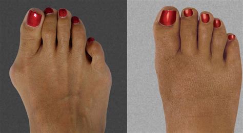 Bunion Surgery Before and After