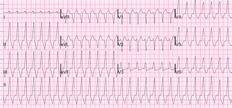 EMCrit - Idiopathic Ventricular Tachycardias for the EM Physician by H Pendell Meyers