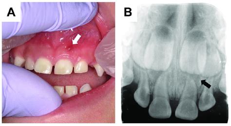 Clinical and radiographic dental manifestations of X-linked... | Download Scientific Diagram