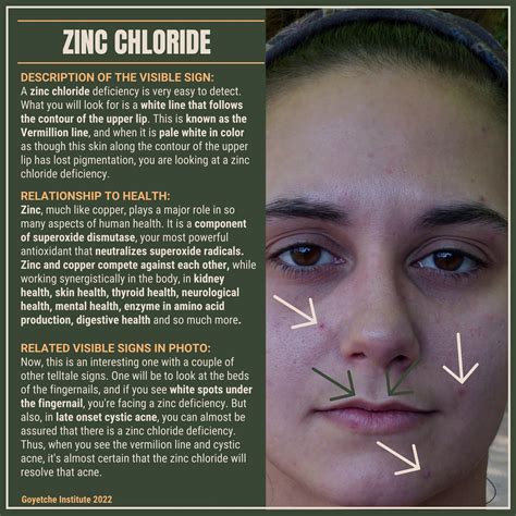 A major indication of zinc chloride deficiency is a white line that ...