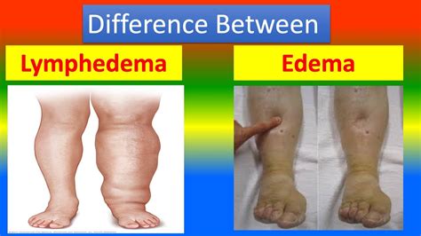 Difference Between Lymphedema and Edema - YouTube