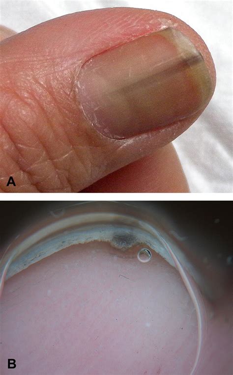 Onychopapilloma presenting as longitudinal melanonychia - Journal of ...