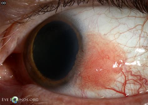 Atlas Entry - Conjunctival squamous papilloma