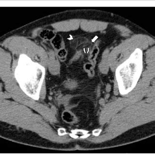 Evolution of acute epiploic appendagitis in a 37-year-old man. a Axial ...