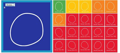 Plagiocephaly severity assessment scale