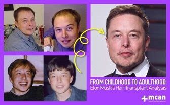 Everything About Elon Musk's Hair Transplant - MCAN Health