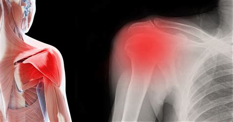 Best Frozen Shoulder Treatment Options For Lasting Pain Relief