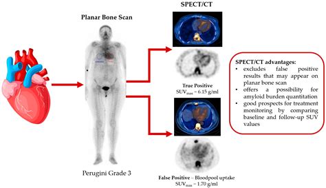 Spect Scan Heart