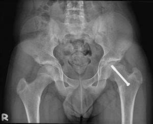 Slipped upper femoral epiphysis – Radiology Cases