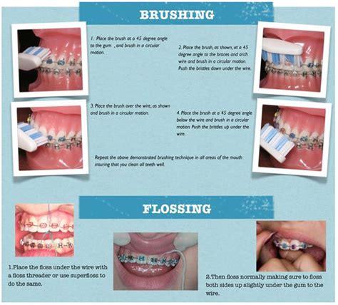 Brushing & Flossing techniques for your Braces