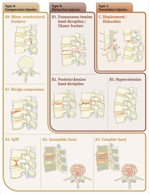 Lumbar Fracture Types