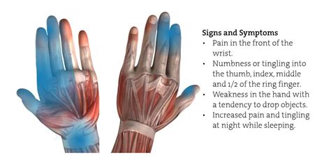 Carpal Tunnel Syndrome Exercise - The Climbing Doctor