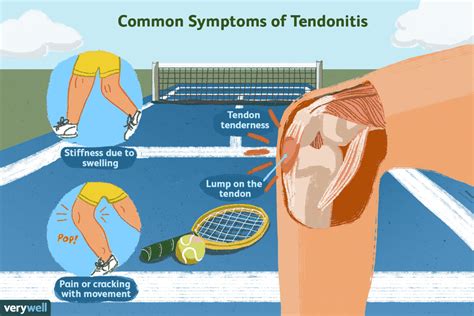 Using Heat or Ice for Knee Pain