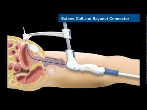 SwanT SPeC Transurethral Suprapubic Cystostomy YouTube - YouTube