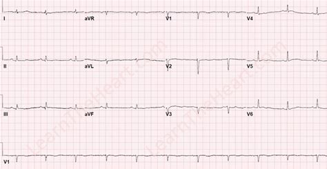 Electrical Alternans - ECG Example 1 | LearntheHeart.com