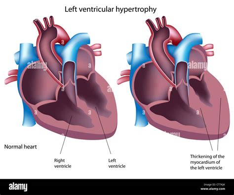 Left ventricular hypertrophy Stock Photo - Alamy