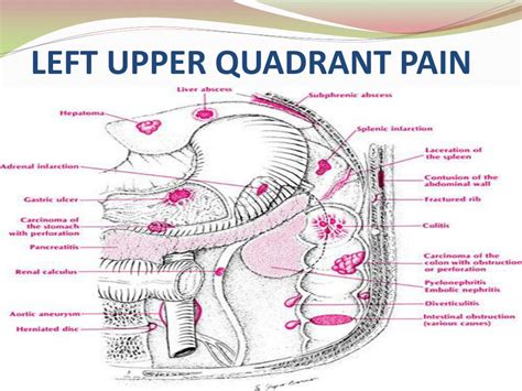 PPT - Left Upper Quadrant Pain and Masses PowerPoint Presentation - ID:434634
