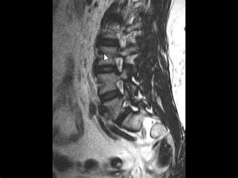 Lumbar Spine MRI - Pars Defect - YouTube