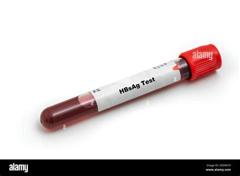 Hepatitis B surface antigen test, conceptual image Stock Photo - Alamy