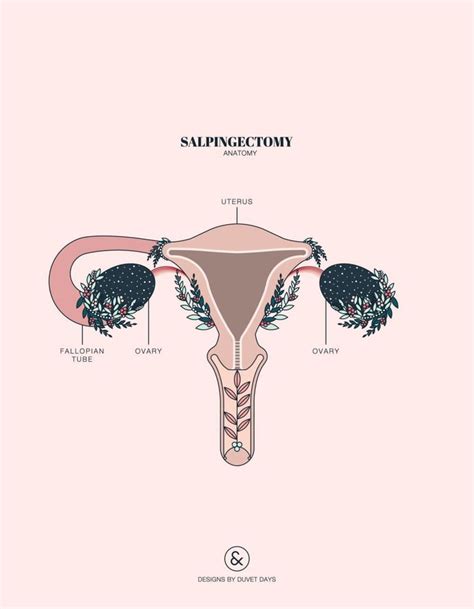 Salpingectomy Unilateral - Designs by Duvet Days Anatomy Illustrations ...