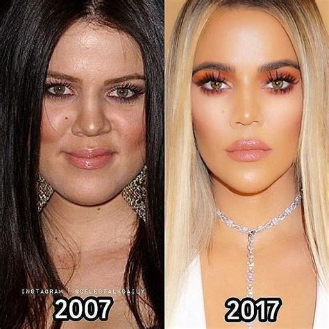 #plastic surgery transformation BEFORE AND AFTER | Kardashian plastic ...