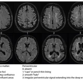 | Fazekas scale for MRI imaging. The figure displays hyperintensities ...