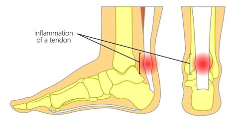 Achilles Tendon Anatomy