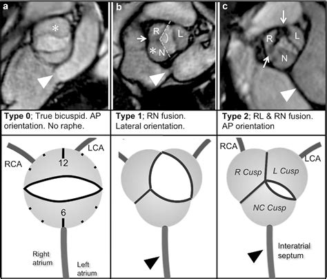 Aortic Valve Leaflets