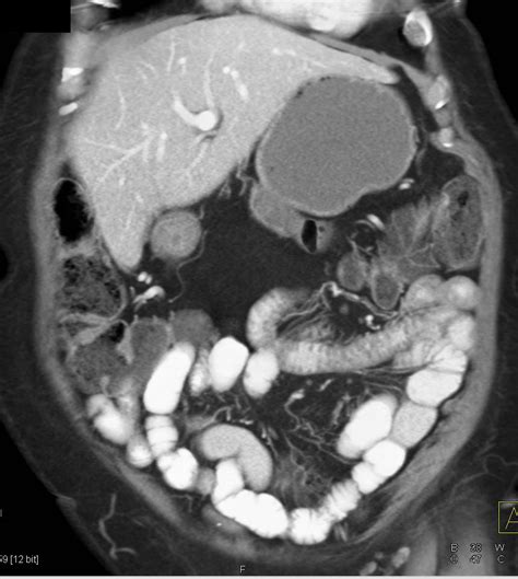 Crohn's Disease with Thick Bowel--- LLQ - Gastrointestinal Case Studies - CTisus CT Scanning