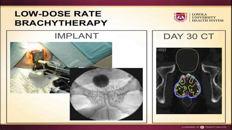 BrachyTherapy - YouTube