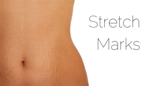 Stretch Marks: Amazing facts about Causes and Treatments | PerfumeA2Z