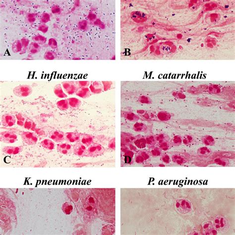 Bacterial morphotypes in sputum Gram stain (×100, oil immersion field).... | Download Scientific ...