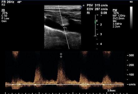 Subclavian steal syndrome - on ultrasound | Image | Radiopaedia.org | Subclavian artery ...