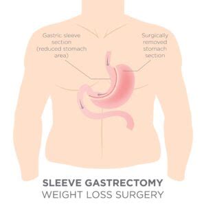 What to Expect After Gastric Sleeve Surgery - Recovery Guide