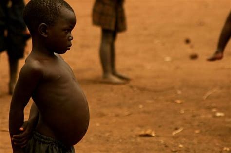 Why Malnourished People Have Bloated Stomachs | The Borgen Project