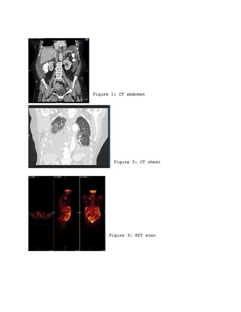 AFMR - Extrapulmonary Tuberculosis: An unusual case of Omental Tuberculosis with Venous ...